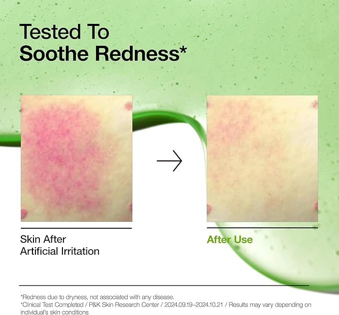 Anua Azelaic Acid 10 Hyaluron Redness Soothing Serum, Facial Serum for Sensitive skin, Hyaluronic Acid, Niacinamide, Spot Care, Natural Color, Vegan, Korean Skincare (30ml/ 1.01 fl oz.)