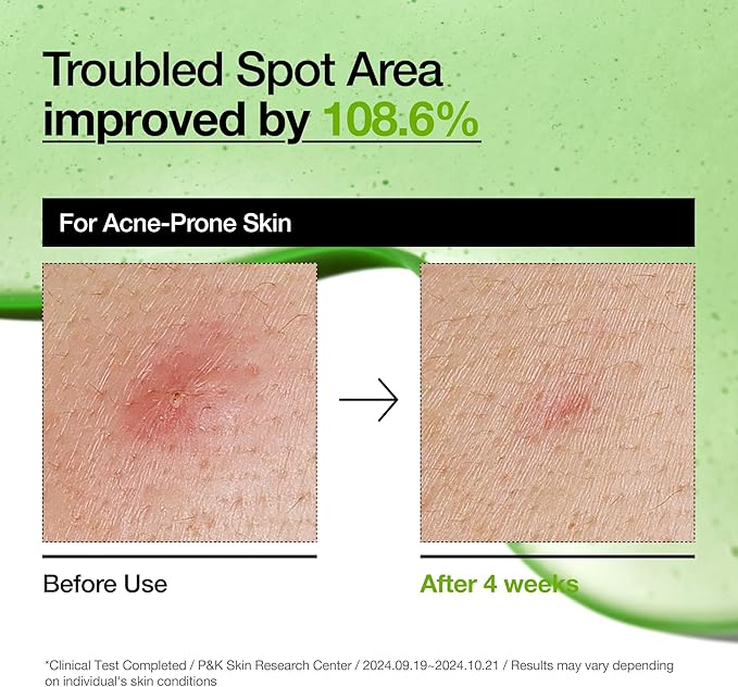 Anua Azelaic Acid 10 Hyaluron Redness Soothing Serum, Facial Serum for Sensitive skin, Hyaluronic Acid, Niacinamide, Spot Care, Natural Color, Vegan, Korean Skincare (30ml/ 1.01 fl oz.)