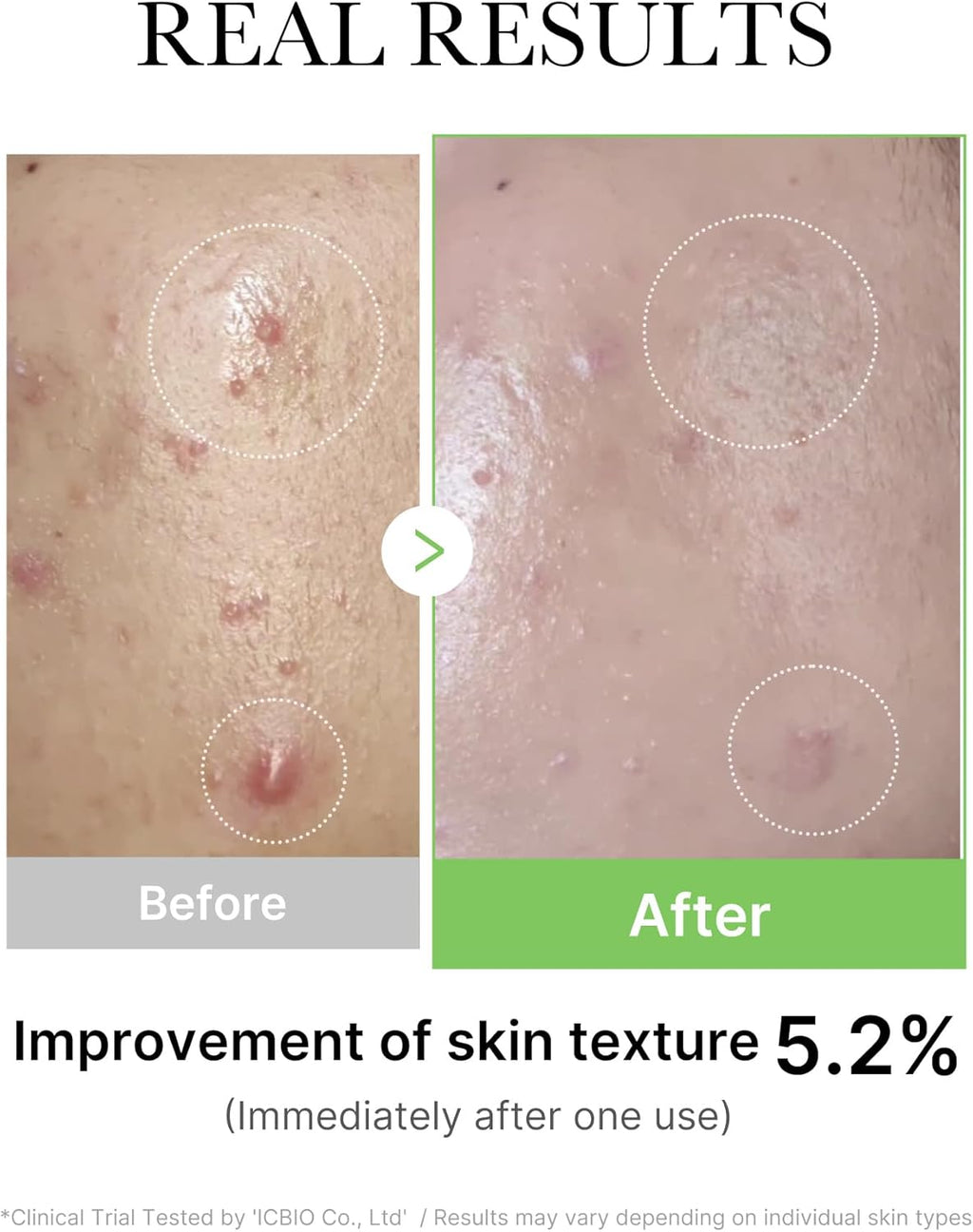 Medicube Exosome Cica Serum 30ml | Tea Tree Ampoule for Sensitive Skin with Centella Asiatica help reduce redness and breakouts. Low-irritating, Moisturizing & Soothing Serum | Korean Skincare