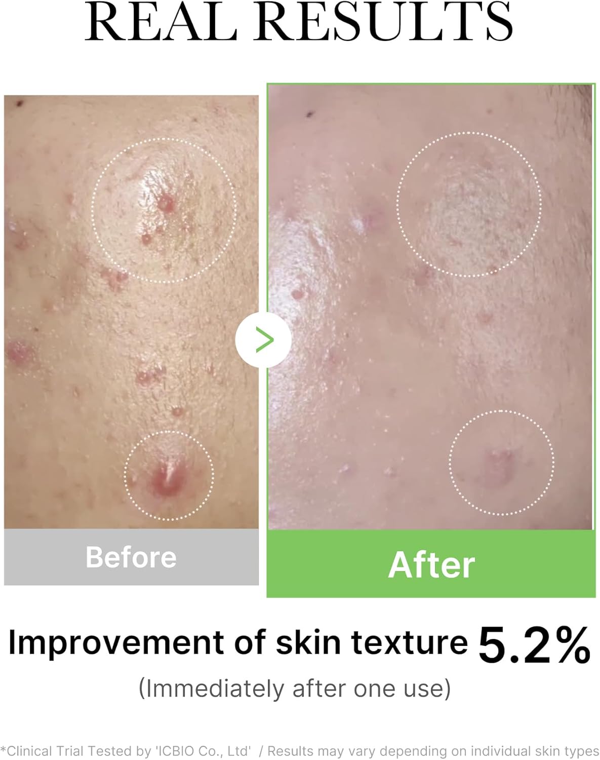 Medicube Exosome Cica Serum 30ml | Tea Tree Ampoule for Sensitive Skin with Centella Asiatica help reduce redness and breakouts. Low-irritating, Moisturizing & Soothing Serum | Korean Skincare