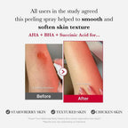 Medicube Red Acne Succinic Acid Peel 40g | Exfoliating Acne Care Peel for Clear & Smooth Skin