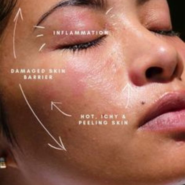 Skin Barrier Repair