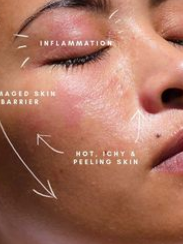 Skin Barrier Repair